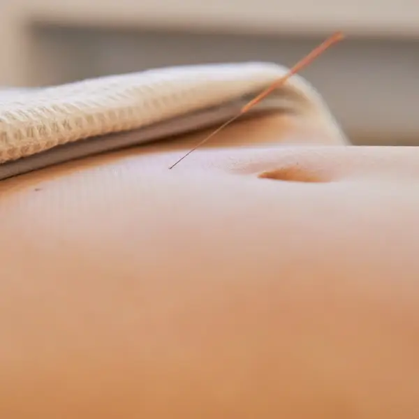 IVF Acupuncture