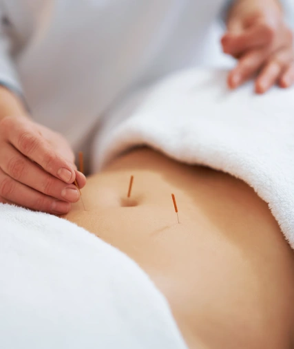 Endometriosis Infertility Treatment - Acupuncture