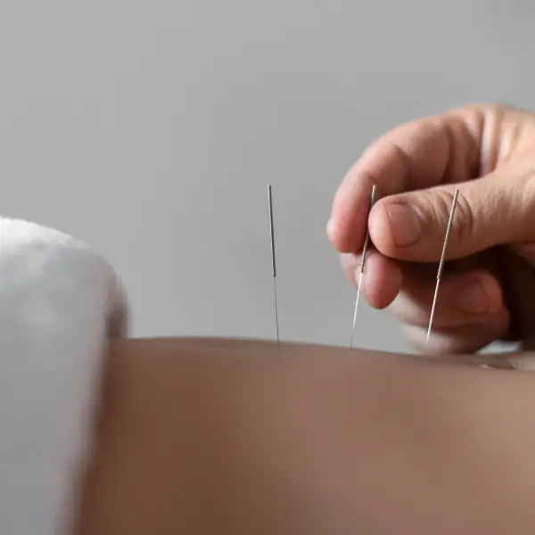 IVF Acupuncture